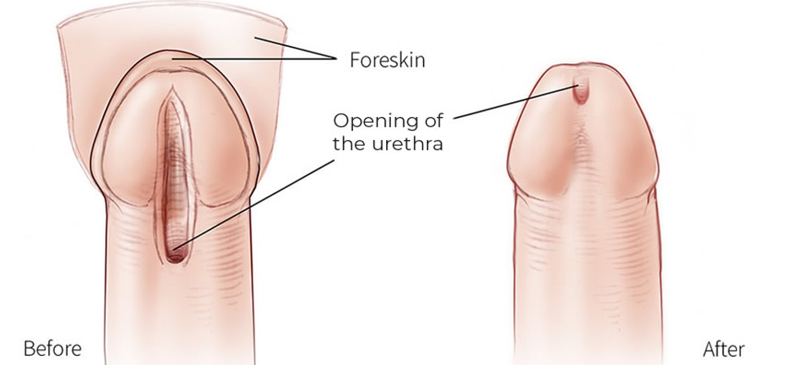 الإحليل السفلي والعيوب الخلقية