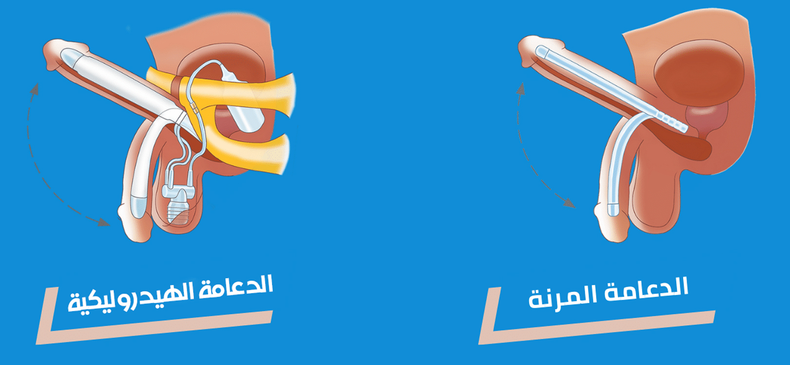 تركيب الدعامة الذكرية المعقدة
