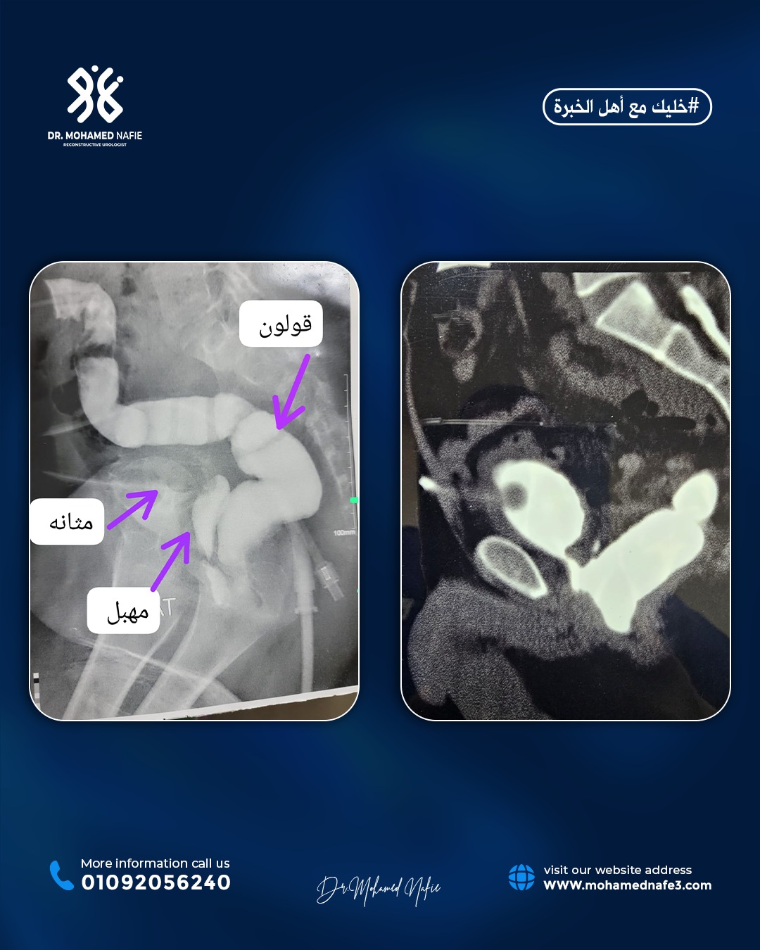 حالة إنسانية لطفلة من الصومال… عندما يصنع العلم أملًا جديدًا للحياة