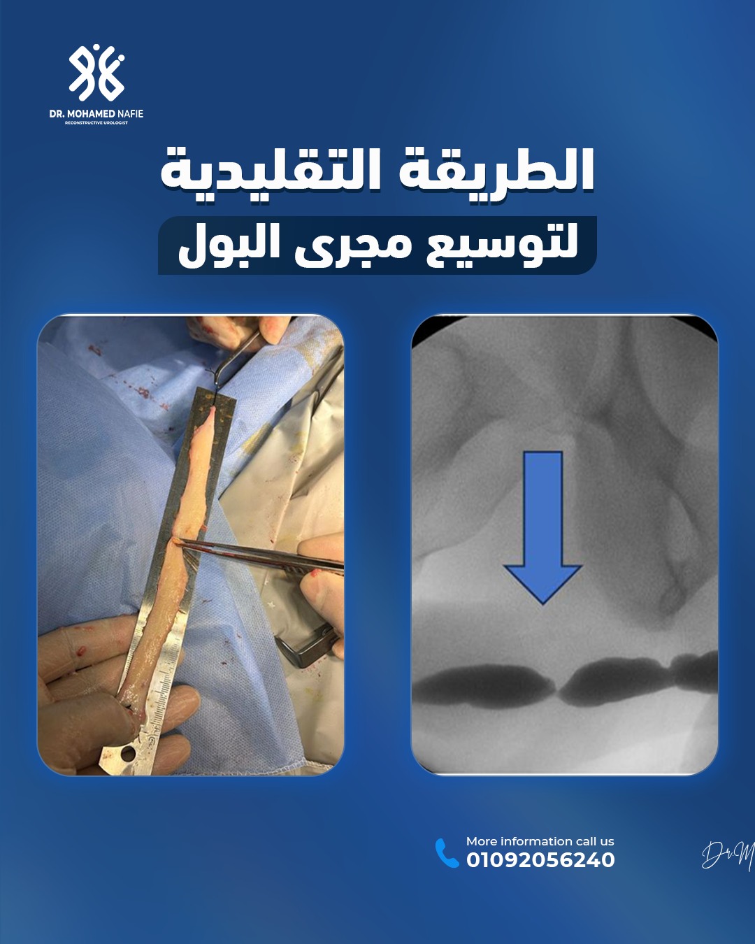 طريقة د. نافع الحديثة لتوسيع مجرى البول