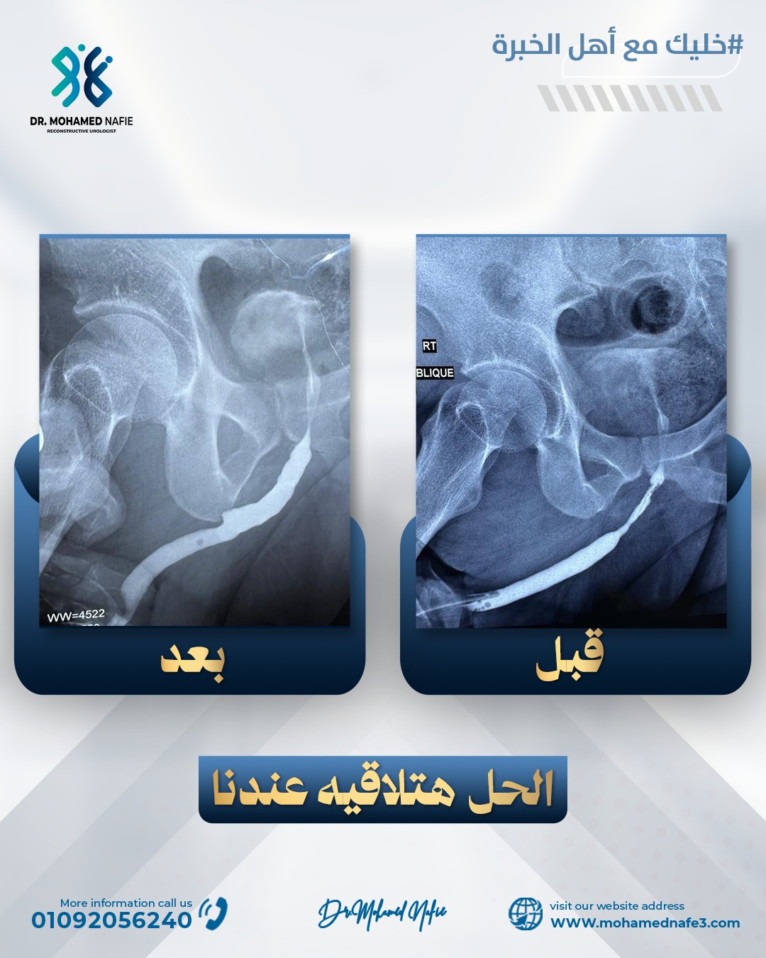  توسيع مجرى البول باستخدام رقعة من بطانة الفم.. الحل الجذري لعلاج تضيق مجرى البول بنتائج طويلة المدى