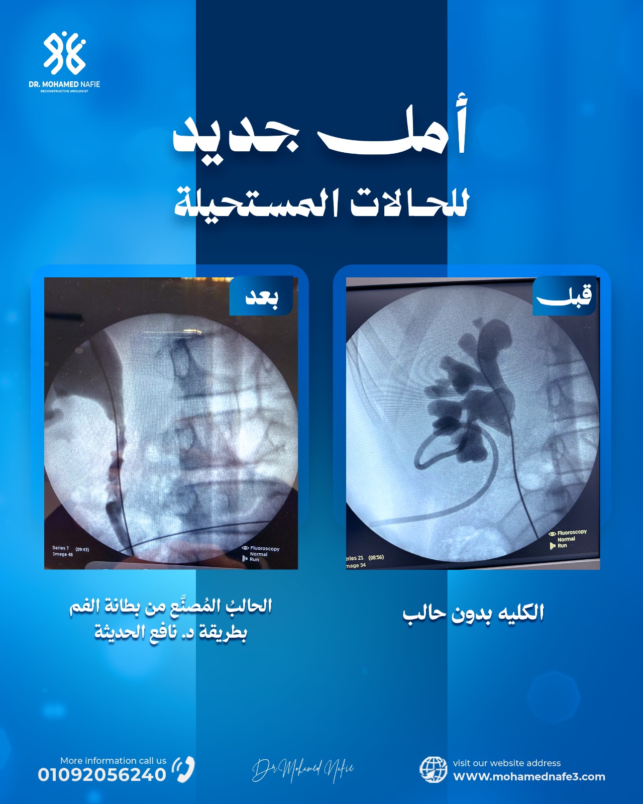 حالة مالك المستحيلة: من قرار استئصال الكُلية إلى بداية عمر جديد