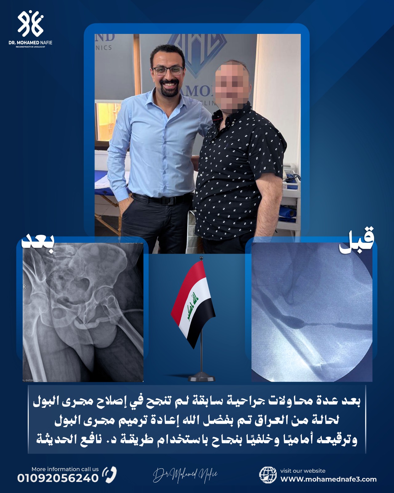 بعد عدة محاولات جراحية غير ناجحة لإصلاح مجرى البول.. نجاح إعادة ترميم معقدة لحالة من العراق