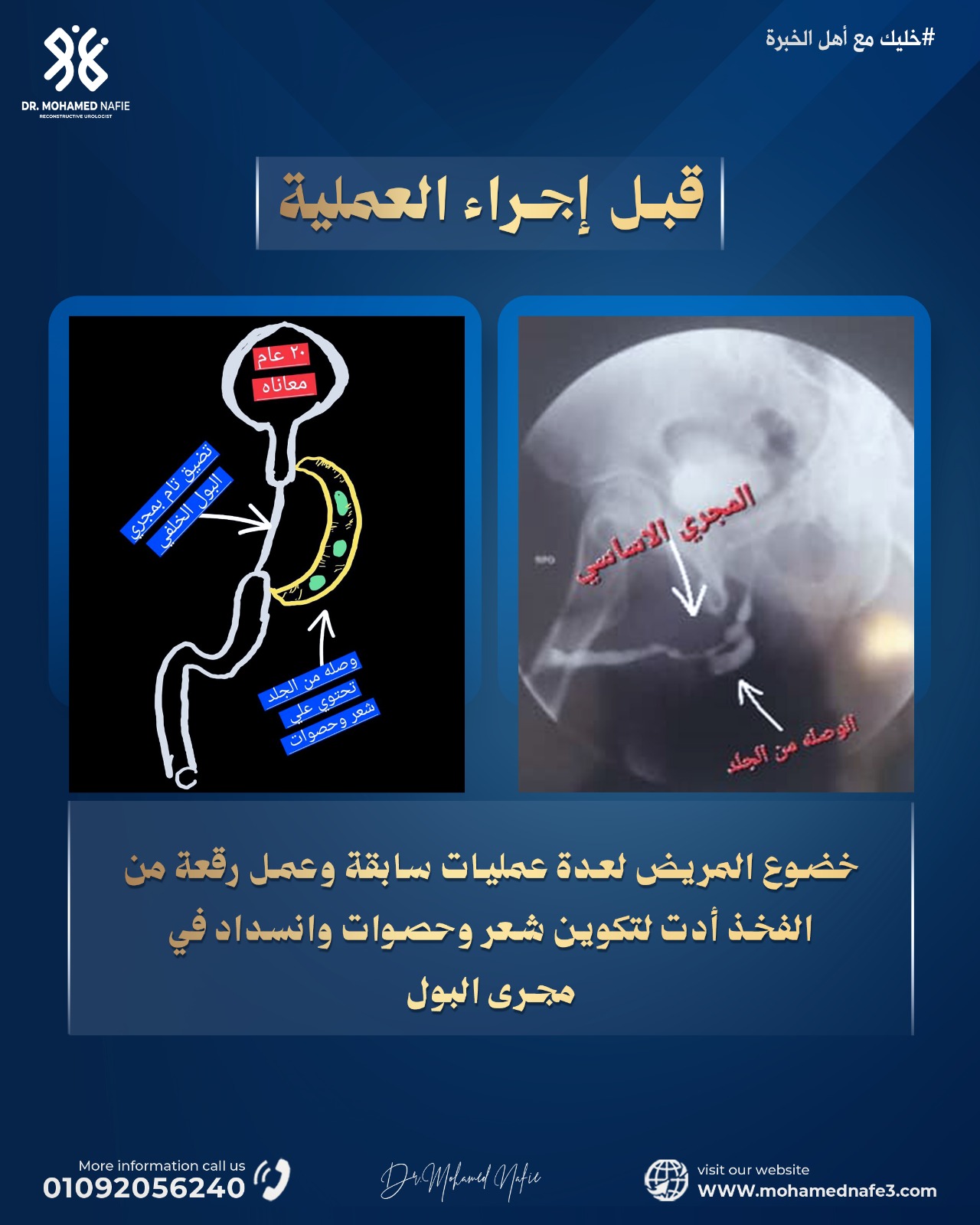 حالة مستحيلة لمريض من ليبيا.. نجاح جديد في إعادة تكوين مجرى البول بعد 20 عامًا من المعاناة