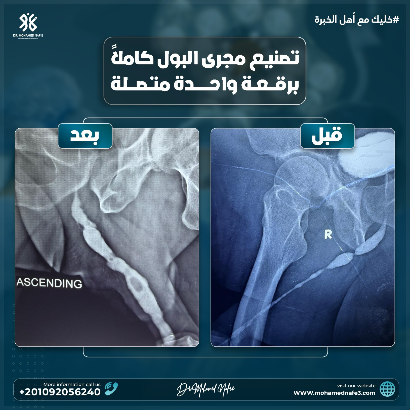 إعادة بناء مجرى البول بالكامل برقعة واحدة من بطانة الفم